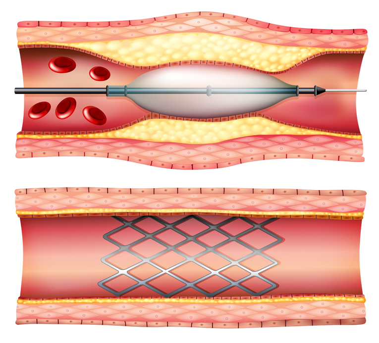 El mandatario provincial fue sometido a una angioplastia con colocación de un stent tras sufrir una angina inestable. Los médicos aseguraron que evoluciona favorablemente y permanece internado por controles de rutina.